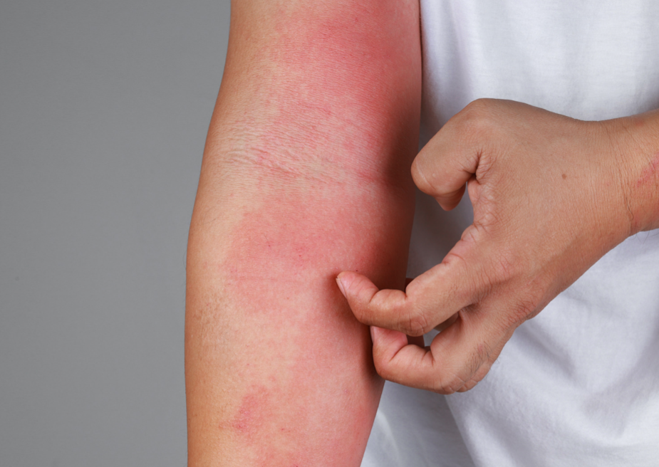 Dermatitis Herpetiformis